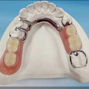 Metal Partial Denture